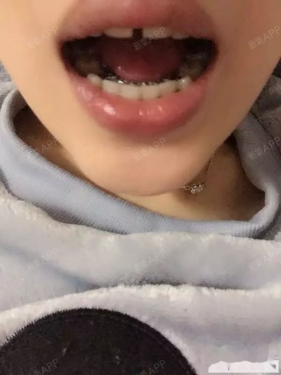 28岁骨性带舌侧牙套!