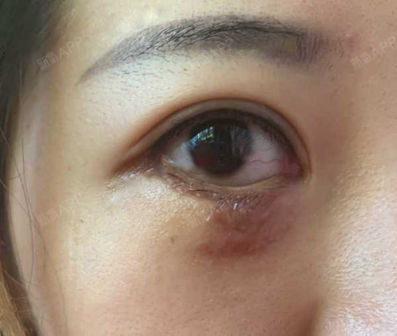 昆明无创疤痕修复好不好_效果图_氧气zsg0z无创疤痕修复术后第8天