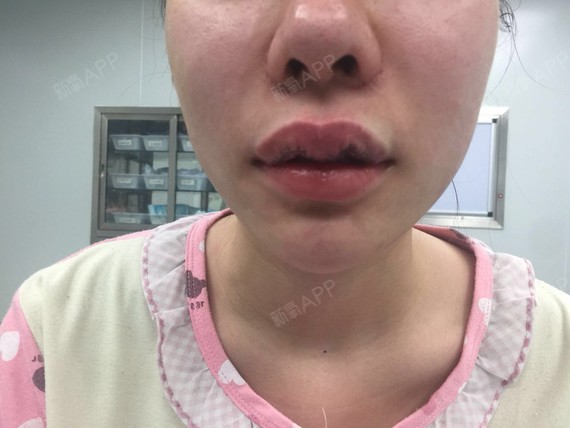 主刀医生:李华刚(院长)手术项目:上唇m唇 唇珠 _圈子-新氧美容整形