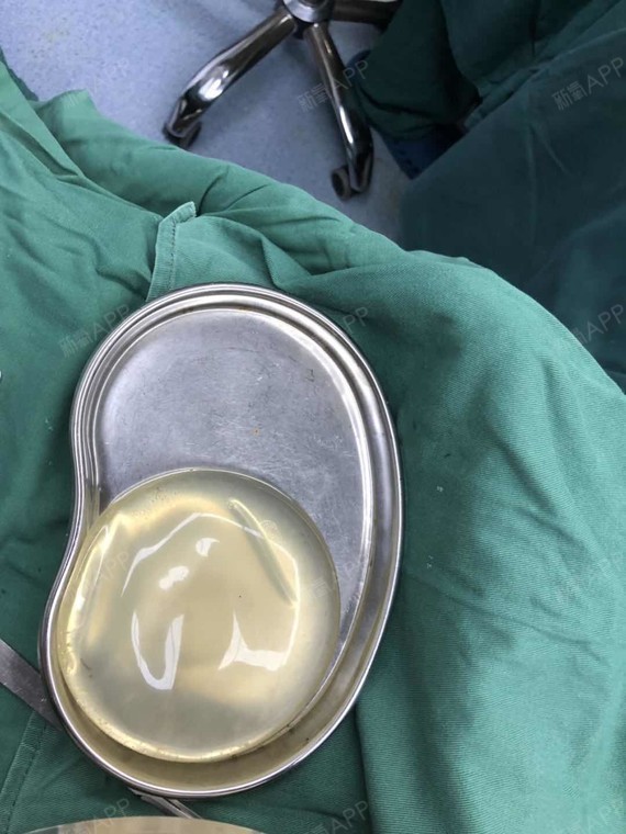 深圳胸部假体取出好不好_效果图_氧气02gyi胸部假体取出术后第0天