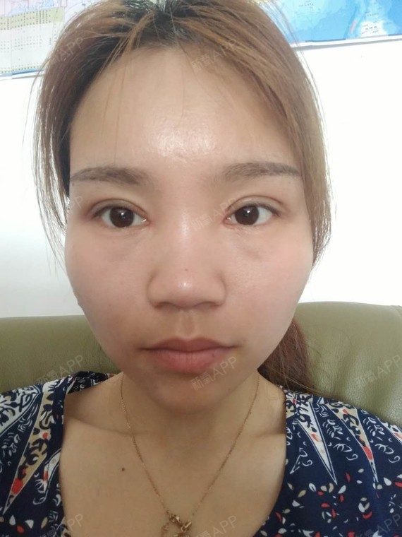 双眼皮越来越自然了,红肿淤青基本消散了_圈子-新氧美容整形