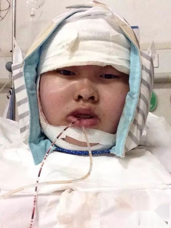 四医大赵晋龙,地包天正颌手术术后两个半月,发个对比_圈子-新氧美容