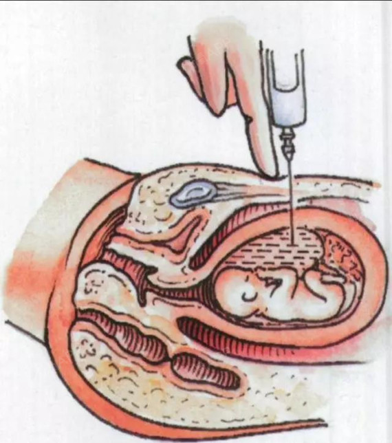 怀孕多久可以做人流,流产的整个过程你的小背