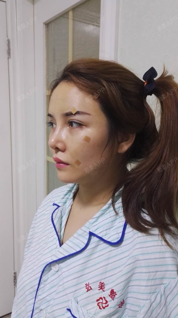 自体脂肪全脸填充好不好_效果图_小鹿斑斑自体脂肪全脸填充术后第0天
