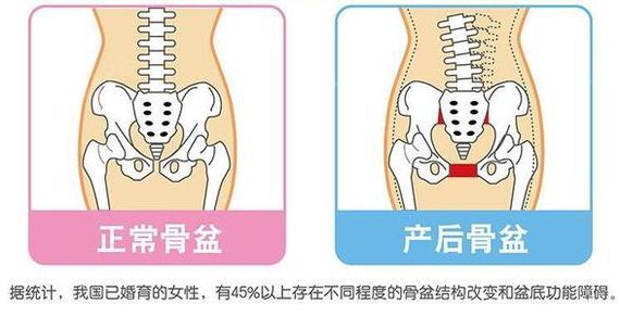 骨盆修复要及时,不要"留"到二胎后才做.