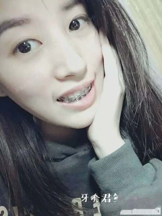 个方丝,医生说下一副方丝一直伴随我到正畸结束  还 说我的牙齿很听话