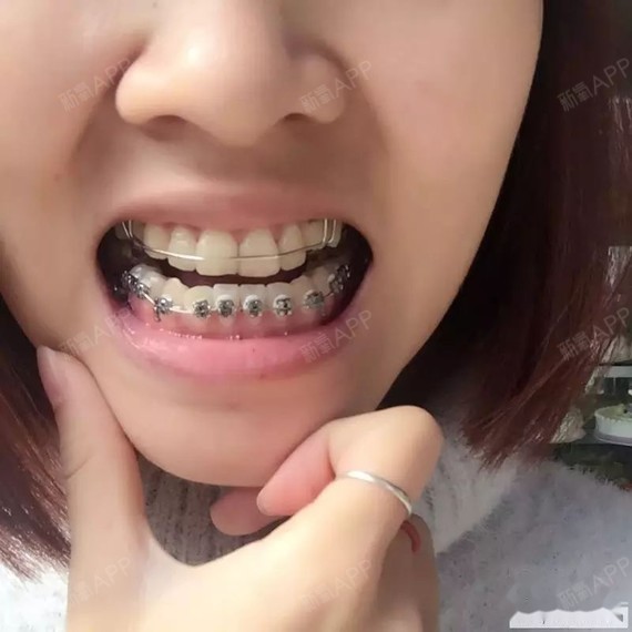 听好多人说戴牙套很痛,今天第一天,一点都不痛,严重的地包牙的