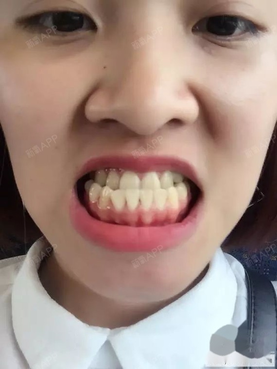 终于戴上牙套了, 终于戴上牙套了,听好