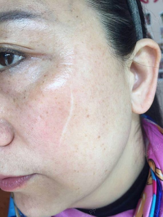 交相关评论氧气esnbx我也是外伤,被铁丝刮到,现在也是这样的白色疤痕