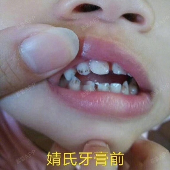 小孩氟斑牙图片图片