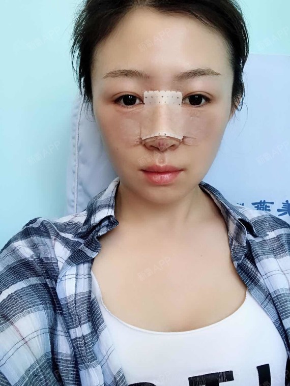 硅胶隆鼻好不好_效果图_咻咻的喵硅胶隆鼻术