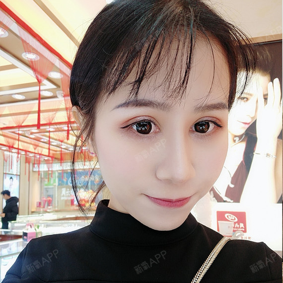 隆鼻取出假体后要注意什么1遵照医嘱服用抗生