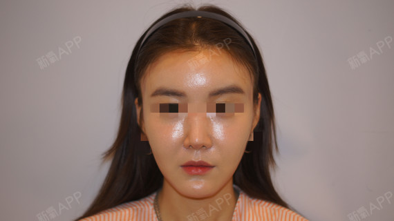 手术前我的颧骨突出,以前误以为面颊凹陷导致,因此打算要做脂肪填充