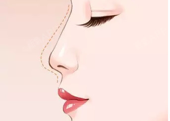 武汉玻尿酸隆鼻的价格是多少呀?如今选择做隆