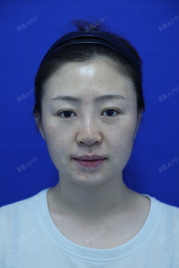 硅胶隆鼻好不好_效果图_咻咻的喵硅胶隆鼻术