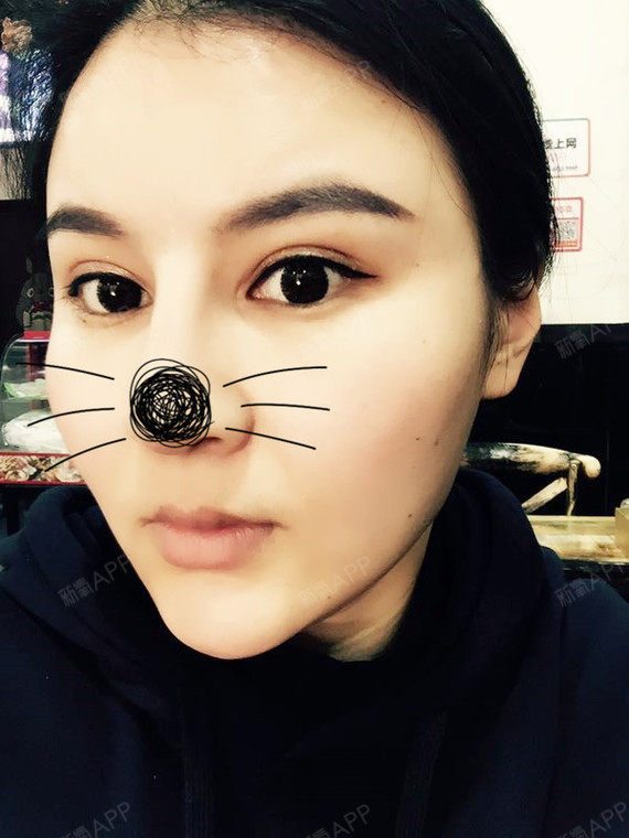 硅胶隆鼻好不好_效果图_滴答滴答y硅胶隆鼻术