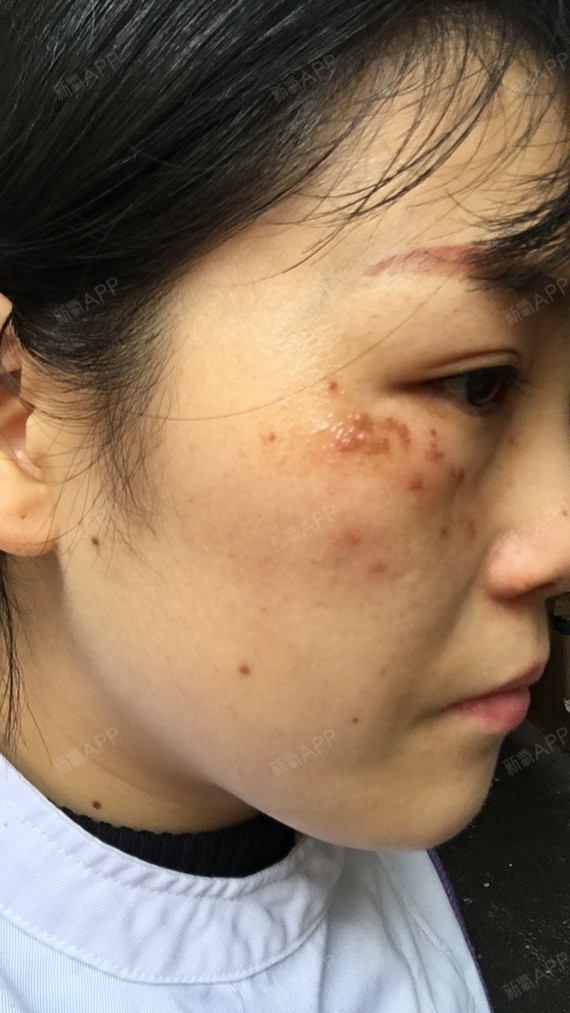 【长沙美莱整形美容医院】今天我的斑点已经开始结痂了,颜色很深,去
