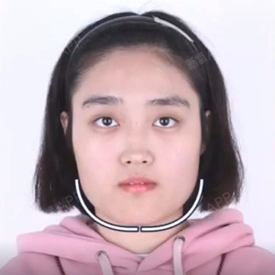 下颌角缩小术说的 方型脸,是指从正面看时成方形的脸.