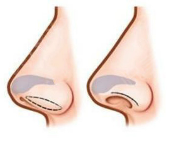 鼻翼缘退缩会导致鼻孔外露,而它跟朝天鼻的病理又不一样,所以用朝天鼻