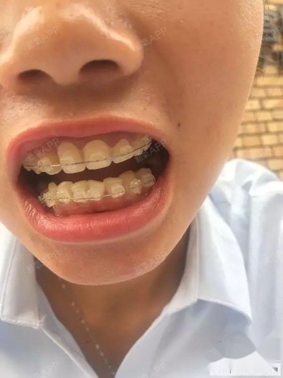 26岁大龄女牙套五个月了变化有木有三颗门牙之前被一个牙科医生忽悠做