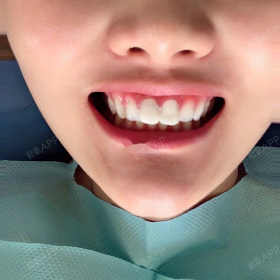 来分享下牙齿健康和牙齿修复问题我选择了美容冠,就是牙套和贴面牙