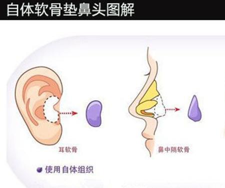 耳软骨隆鼻要多久的恢复期 术后应该怎 新氧 专业医美服务平台