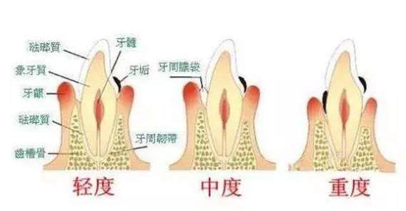 牙齦萎縮吃什麼藥能好