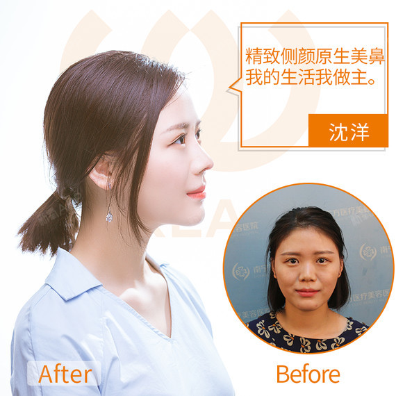 自体软骨隆鼻,是将耳软骨、肋软骨、鼻中隔软