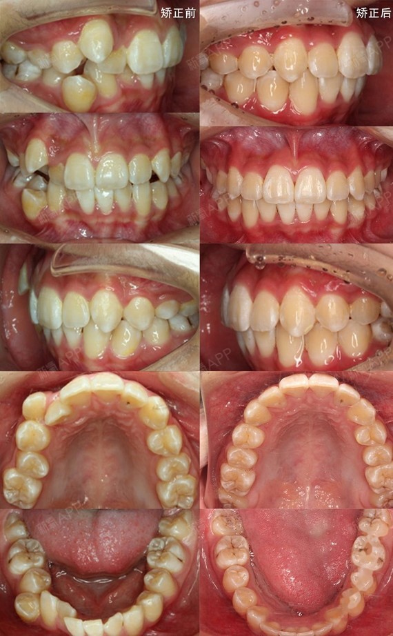 牙齿矫正案例|虎牙女生不拔牙矫正,14个月纠正歪头_圈子-新氧美容整形