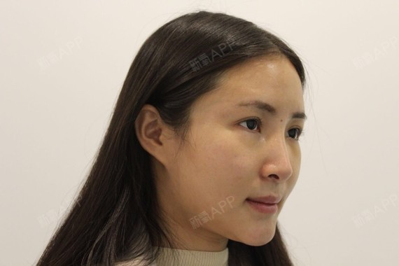 丰唇能维持永久的吗_丰唇可以维持多久_丰唇可以恢复吗