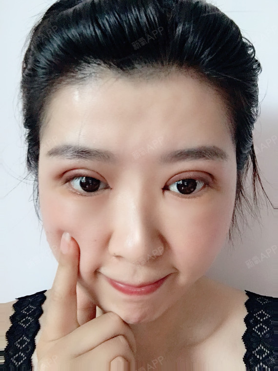 双眼皮第二天了,眼睛肿的厉害,但是的确做完以后眼睛_圈子-新氧美容