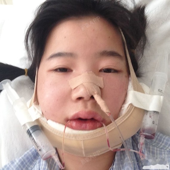 [正颌手术日记] 北口术后三个