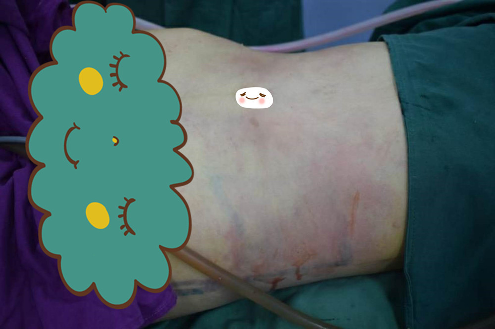 吸脂瘦腰腹怎么样_恢复过程_效果如何_氧气1ry1v整形日记1.