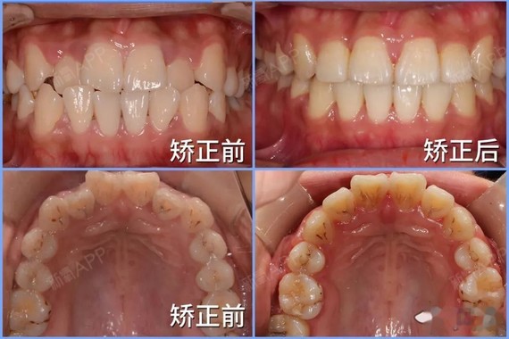 少女通過劉醫生的矯正恢復了良好的咬合關係,獲得了柔和的面部線條.