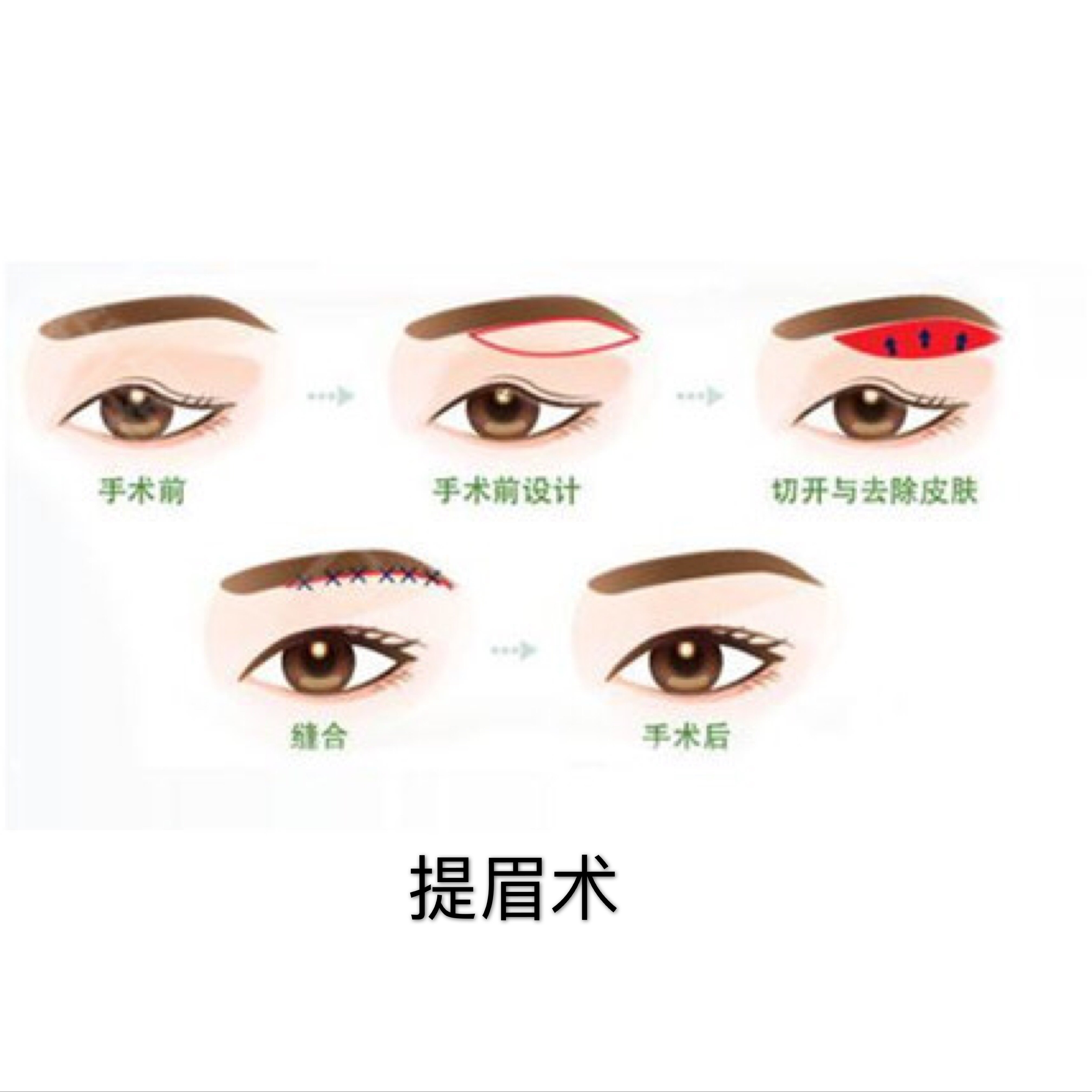 什么叫做眼综合?为什么医院总喜欢推荐做综合,只做双眼皮不行吗?