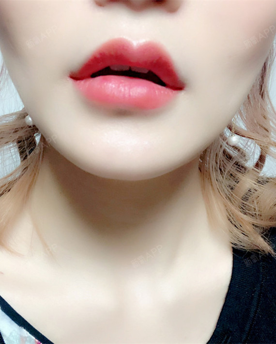 医院:韩国欧佩拉项目:玻尿酸m唇 嘴角上扬肉毒素注_圈子-新氧美容整形