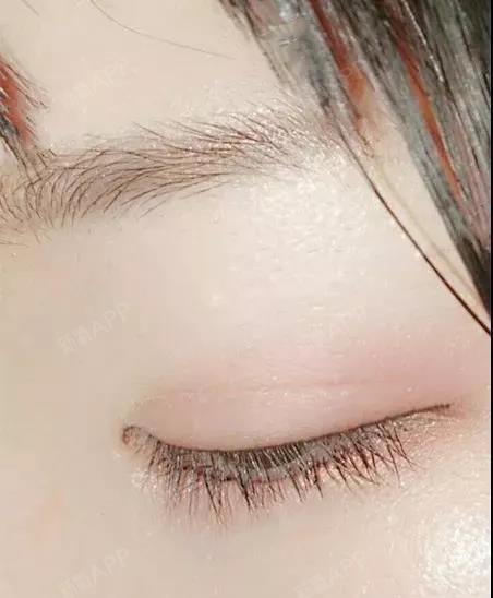 割完双眼皮这样做,7天恢复超自然!鉴于最近手