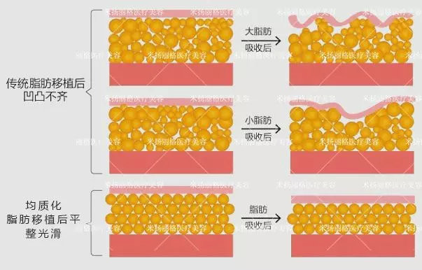 填充面部脂肪保持多长时间_面部填充脂肪可维持多久_脂肪面部填充保持多久