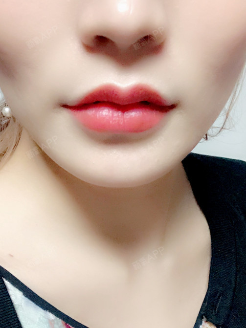 医院:韩国欧佩拉项目:玻尿酸m唇 嘴角上扬肉毒素注_圈子-新氧美容整形