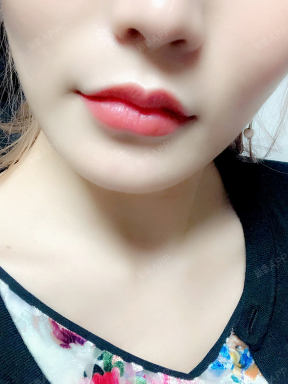 医院:韩国欧佩拉项目:玻尿酸m唇 嘴角上扬肉毒素注_圈子-新氧美容整形