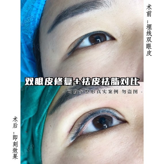 割双眼皮方法一:埋线双眼皮手术法,是通过缝合