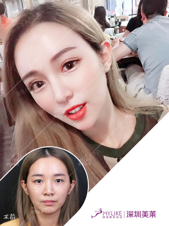 埋线双眼皮手术是指通过缝合的方式,是直接把