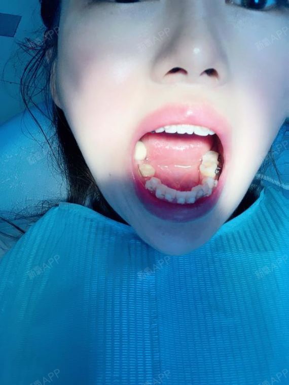 昨天晚上临时牙掉了并且上面还黏着牙套,晚上