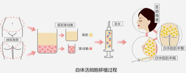 自体脂肪填充后形态自然吗 填充后对形 新氧美容整形