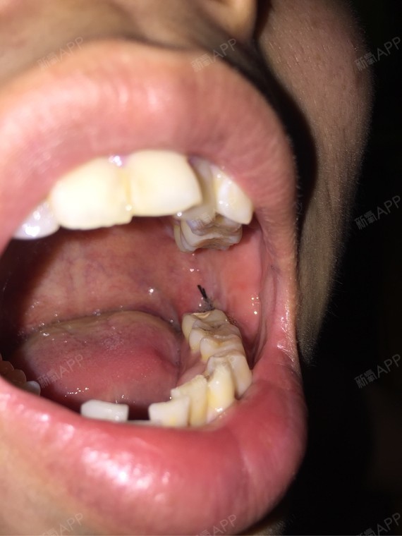 仔细看看,右边的下颚智齿 已经顶住磨牙蛀穿了里面 根管