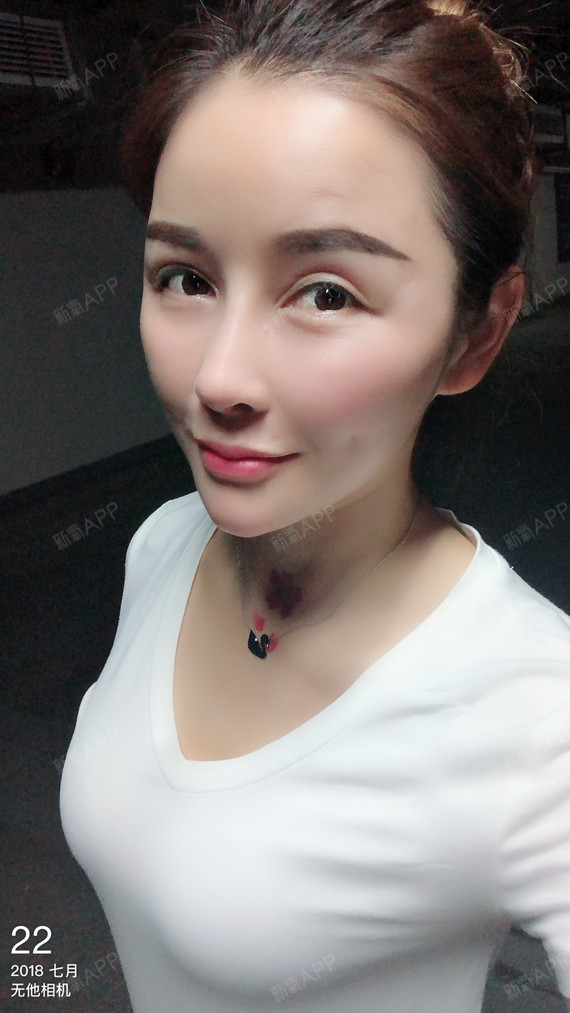 硅胶隆鼻好不好_效果图_一朵云霞硅胶隆鼻术