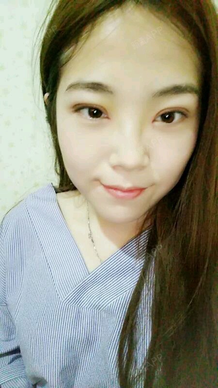 眼部综合好不好_效果图_氧气zq82u眼部综合术