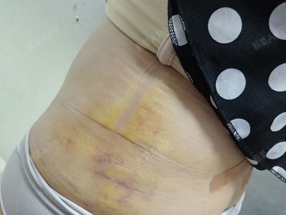我这次主要是做吸脂瘦腰腹,现在还在肿胀阶段,淤青也特别明显,医生说