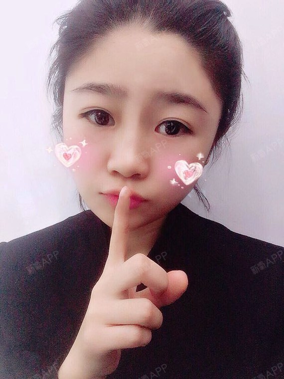 眼部综合好不好_效果图_氧气zq82s眼部综合术