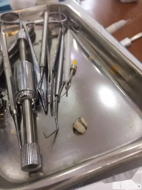 正能量!30岁大龄,门牙烤瓷牙,不拔牙矫正中从小